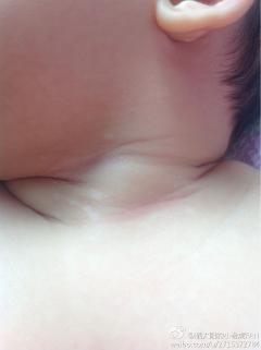 宝宝脖子下面起了白色……