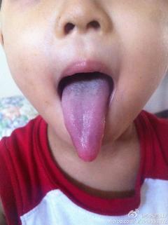 帮我看下我儿子舌苔有……
