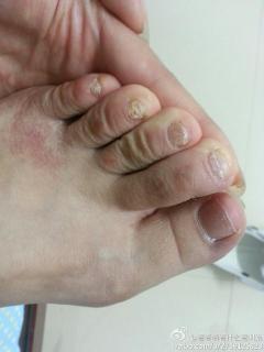 从去年开始脚指甲变形……