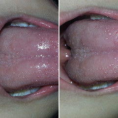 小孩舌头有像水泡的是……