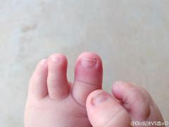 宝宝四个月，脚趾貌似……