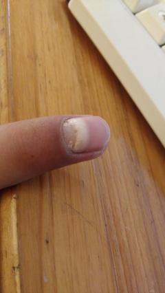 我的手指指甲长了一个……