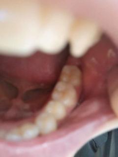 牙齿与牙龈分离 后面……