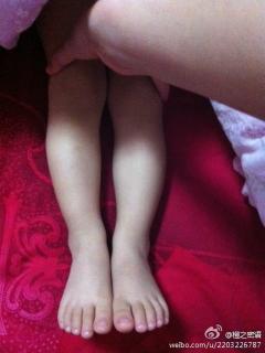男宝1岁2个月，左脚……