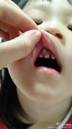 我女儿口腔上门牙的牙……