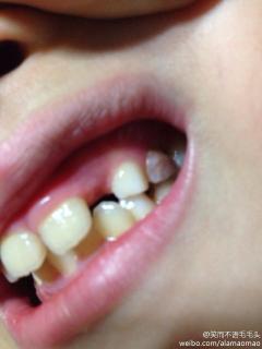 孩子乳牙去年因龋齿做……