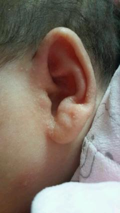  求助，宝宝耳朵里有……