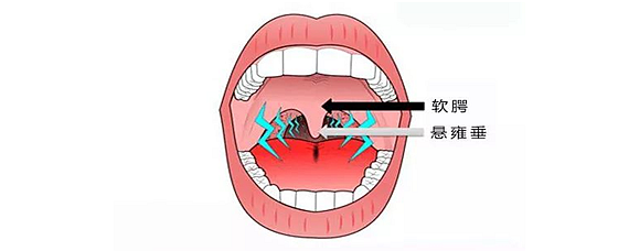 软腭缺失图片